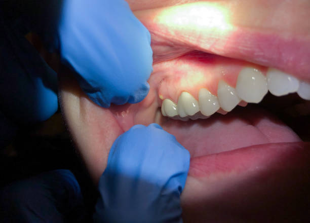 Best Emergency Treatment for Oral Infections in Enterprise, WV